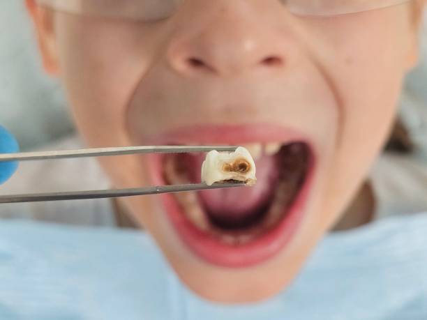 Best Broken or Cracked Tooth Emergency Dentist in Emerson, NJ